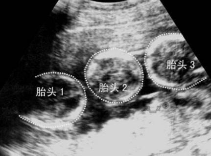 运城市中心医院做三代试管成功率如何？一文读懂需要花多少钱